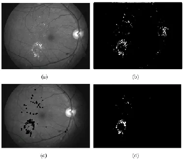 Figure 4. Detection of Hard exudates (a) Intensity 