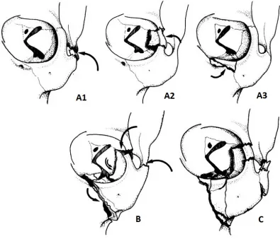 Figure 1-2 – Fracture classification system as described by Zingg et al23. 