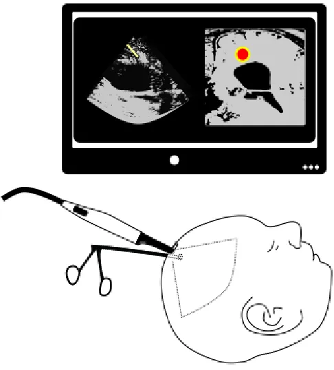 Figure 2: Tracked ultrasound-guided biopsy 