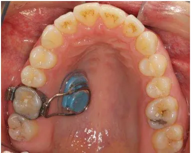 Figure 1 - TheraMon® microsensor embedded in acrylic and attached to two intraoral 