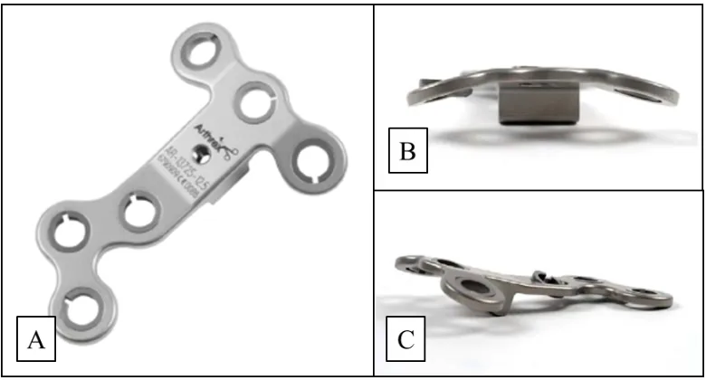 Figure 6: A) The Arthrex ContourLock HTO Plate® design (Arthrex, Naples, FL) 