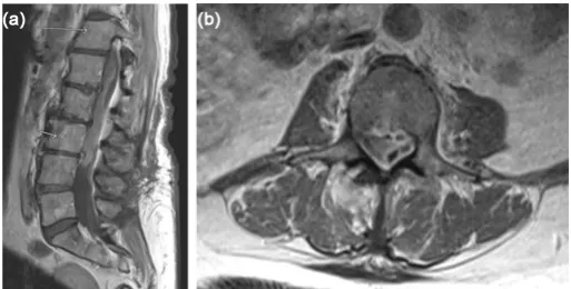 Figure 1. (a) Pre-operative sagittal T-1 weighted post-contrast MRI of the lumbar spine shows diffuse subdural collection with no evidence of epidural extension