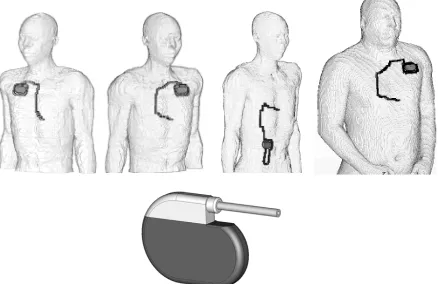 Figure 1. Numerical models of pacemaker patients repre- senting an average European man with right pectoral, left pectoral, abdominal implantation, based on the modified model NORMAN as well as the obese model with left pec-toral implantation (from left to