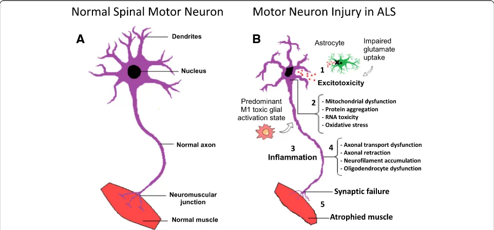 Fig. 1 Molecular mechanisms in the pathology of amyotrophic lateral sclerosis.bglutamate clearance leads to neuronal excitotoxicity; 2) Defects in protein degradation pathways and disturbances in RNA processing result inprotein aggregate formation, RNA tox