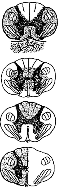 Figure 2.5: Incomplete Syndromes (Ref. Grundy et al, 1986)