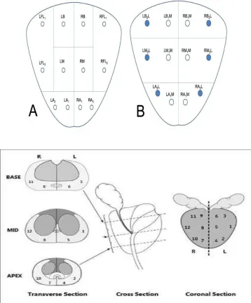 FIGURE 4 & 5: SITES OF PROSTATIC BIOPSY: 