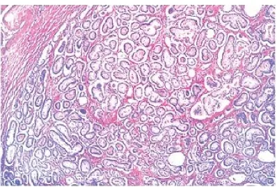 FIGURE 10: GLEASON PATTERN II 