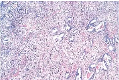 FIGURE 12: GLEASON PATTERN IV 
