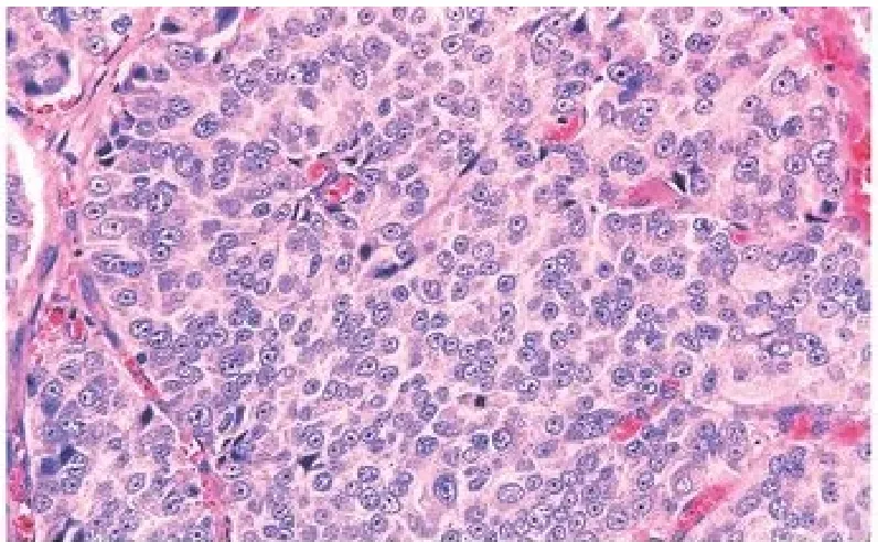 FIGURE 13 :GLEASON PATTERN V 