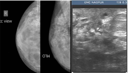 Figure 4. A case of ductal carcinoma breast. Irregular mass in superomedial quadrant of right breast with spiculated 