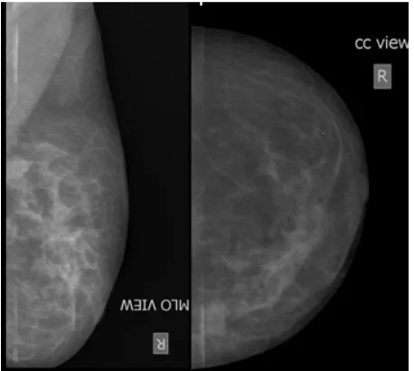 Figure 9. A case of simple cyst. Mammography reveals rela- tively well marginated, soft tissue density lesion involving subareolar region in a 33 years old female with complaints of lump in the left breast since 6 months