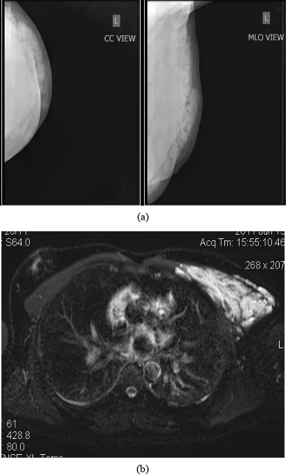 Figure 12. A case of pectoraajor muscle hemangioma. Well defined radio-opacity involving supero-lateral and in- compressible cystic spaces within the mass (not shown); (b) ferolateral quadrant of left breast with lobulated margins not separately visualized