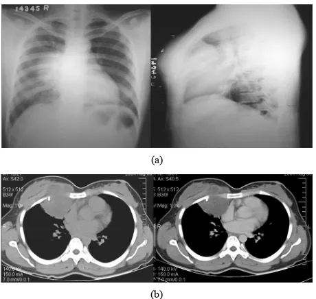 Figure 13. A case of chondrosarcoma of the rib. (a) Radio- trast CT thorax Mediastinal window reveals relatively non enhancing mass lesion involving right anterior chest wall with rib destruction and intrathoracic extension