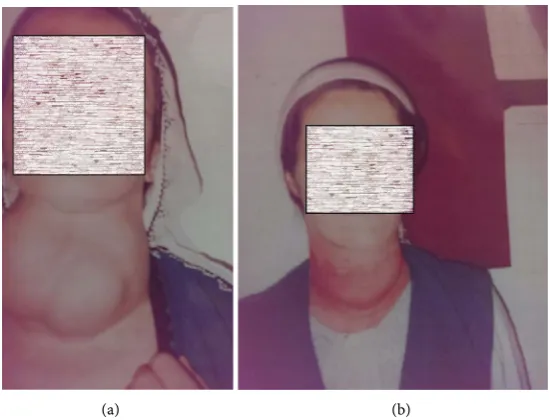 Figure 1. (a), (b) In this case, right site injury of the superior laryngeal nevre. 