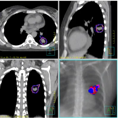 Figure 3.2: Slices of physician provided segmentations for patient E. The GTVson diﬀerent axes are shown at top left, top right and bottom left, while thebottom right image shows the superimposed 3D meshes for all segmentations.Top left shows a slice at z = 52.7, top right shows slice x = 5.62 and bottomleft shows slice y = −18.485.