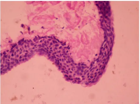 Figure 2. Squamous epithelium passes on the cyst wall. He-matoxylin eosin staining (400×)