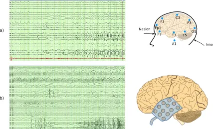 Figure 1.6: Temporal lobe seizure captured with EEG. a) seizure recorded using the traditional 10-20system b) seizure recorded using subdural electrodes (24 channels per lobe)