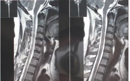 Figure 1. Bilateral white matter T2 hyperintense lesions in subcortical and priventricular area of brain in axial images