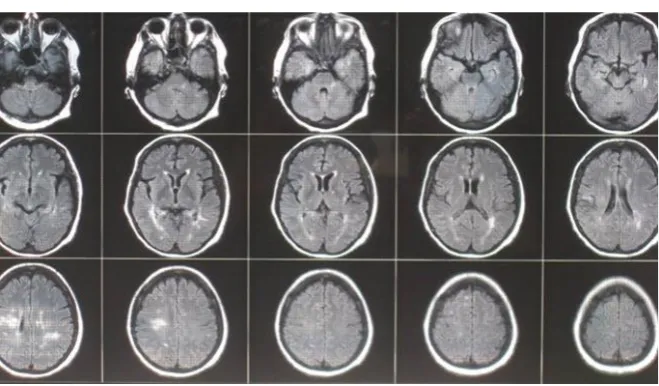 Figure 3. Multiple white matter T2 hyper intense lesions in supra and infra tentorial re-gions in axial T2 FLAIR brain images