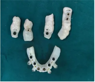 Fig 6 DIGITALLY PLANNED 3D PRINTED SURGICAL STENT. 