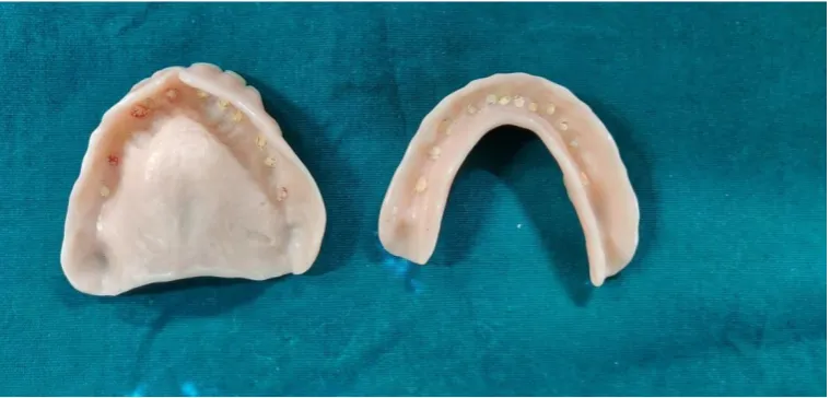 Fig 17  GUTTA PERCHA STICKS INSERTED IN TO THE ACRYLIC TEETH OF THE COMPLETE DENTURE. 