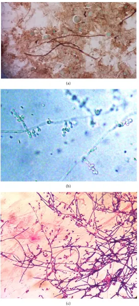 Figure 1. Cytological smears: (a) Nose skin scraping stained with Grocott’s methenamine silver (GMS), hyphae, budding yeast and blastoconidia were identified; (b) Direct micro-scopic examination with 10% KOH of pubic ulcer smear showed blasto conidia, and 