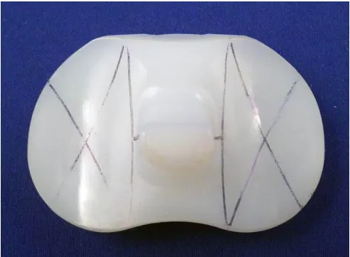 Figure 1.5: A retrieved tibial 