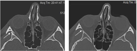 Figure 1. Postoperative photographs 9 months after ZMC fracture repair using a Steinmann pin