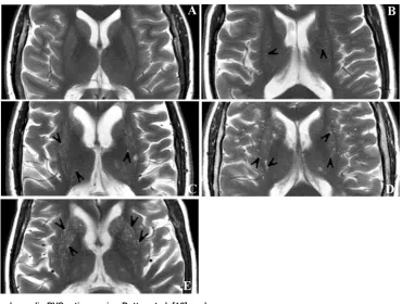 Figure 2. Basal ganglia PVS ratings using Potter et al. [16] scale.