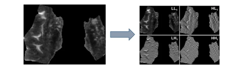 Figure 3. Graphical representation of the steps for delineation of the basal ganglia regionpolygon; (Steps of the BG segmentation: (A) Detection of the vertices in the insular cortex (1), lateral ventricles (2) and genu (3); (B) creation of theC) subtraction of the CSF from the BG polygonal region and (D) segmented BG region.