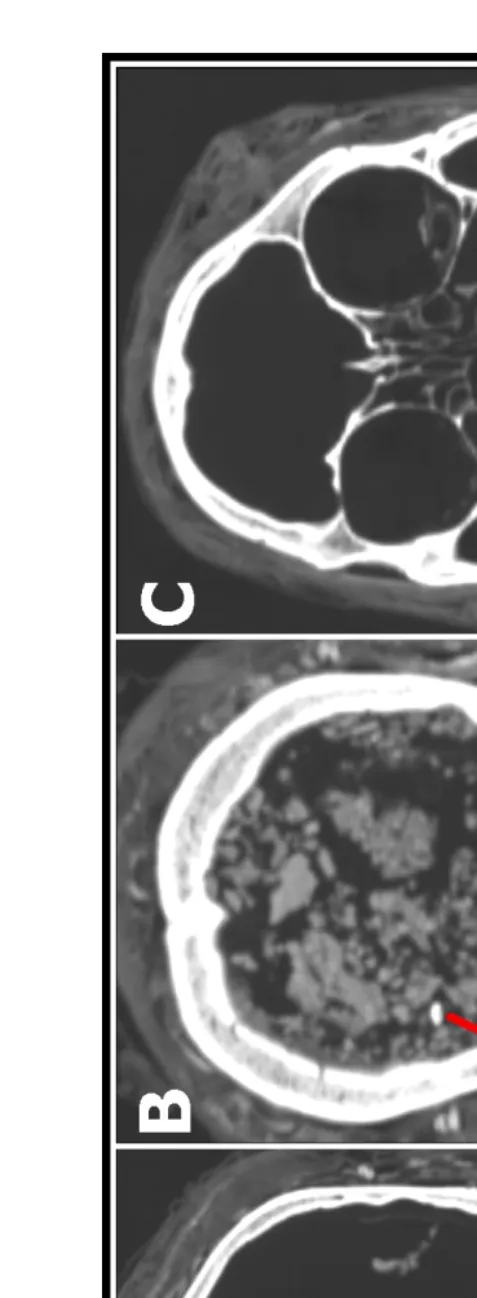 Figure 6. CT scan of the Sulman mummy, showing (A) the intact rotated brain, (B) the granular fragmentation of the brain posteriorly, a potential basilar occiput fragment (indicated), and (C) the intact conchae, nasal septum, and ethmoid air cells