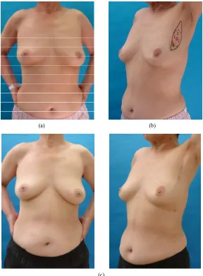 Figure 3. (a) The resected spindle-shaped area of columnar tissue and excess skin; (b) One-year postoperative findings (Case 1)