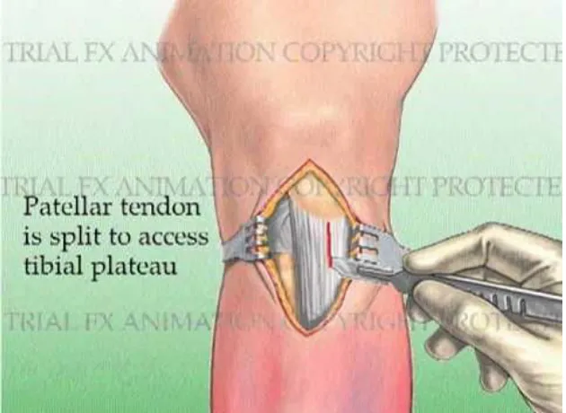 Figure 7.  Approach for Intramedullary Nailing41 