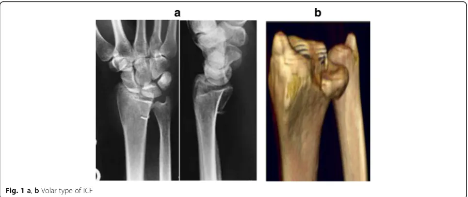 Fig. 2 a, b Dorsal type of ICF