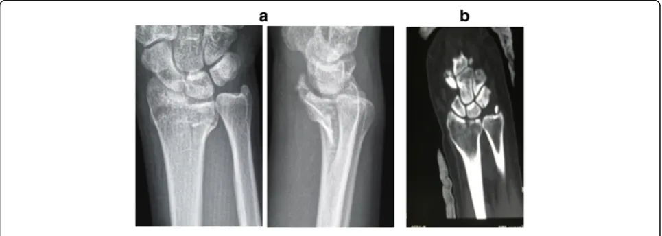 Fig. 3 a, b Split type of ICF