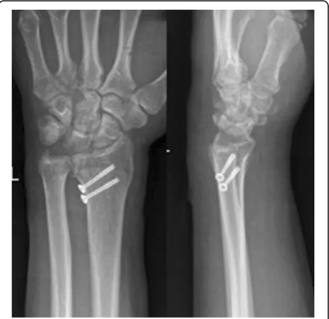 Fig. 6 a, b ICF with collapse accompanied with split type