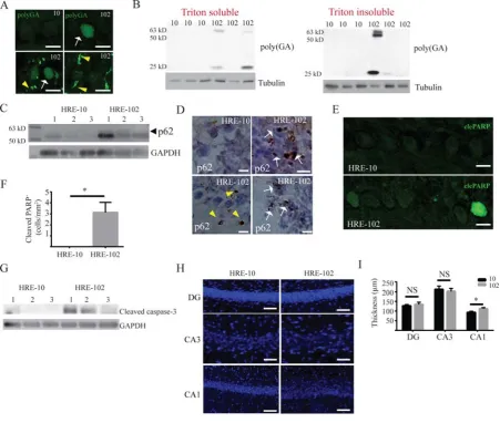 Figure 2. Dipeptide protein repeat (DPR) pathology, hippocampal CA1 dispersal, and 