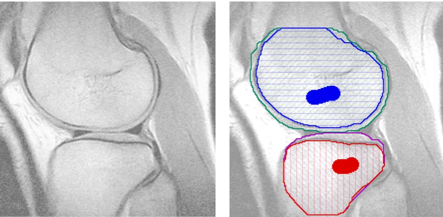 Figure 3.7: User-driven heart segmentation using the non-submodular interaction portrayed in (3.8),solved by QPBO-I
