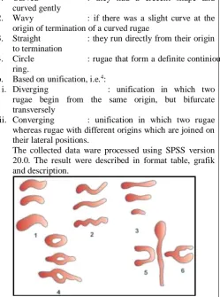 Table 1 shows the distribution of palatal rugae patterns by sex. Based on shape, men have the most 