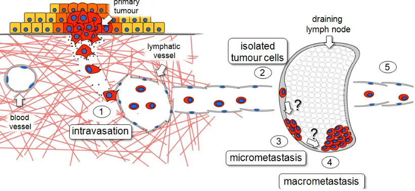 Figure 1.1 Schematic diagram of the progression of lymphatic metastasis.