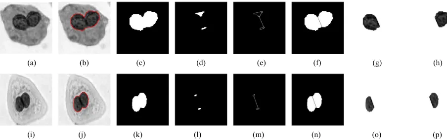 Figure 11. Three-parallel cervical cell body (no hole) separation result. (a): Three-parallel cervical cell image; (b): Cell body contour curve; (c): Binary image of the cervical cell; (d): Concave regions of the cell body; (e): Separating points connectio