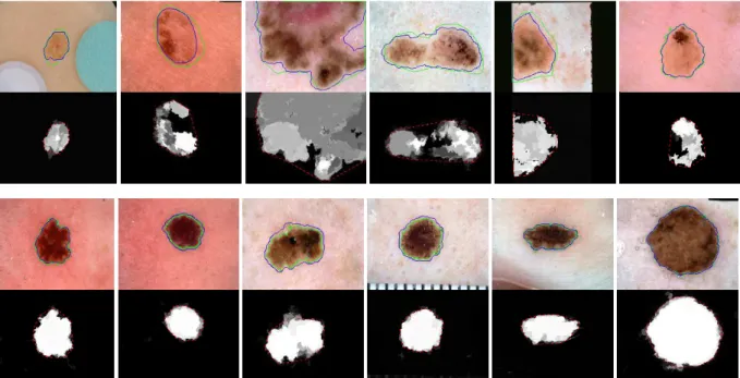 Fig.  9.    Qualitative  assessment  of  the  proposed  segmentation  method.  The  first  and  the  second  row  illustrates  six  example  of  extreme  cases  with  their  corresponding saliency maps through mDRFI