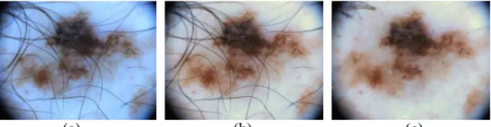 Fig.  3.    Image  preprocessing  procedures  applied  to  a  sample  dermoscopic  image:  (a)  original  image  occluded  with  hairs  and  showing  a  shade  of  blue  color, (b) applying Shade of Gray algorithm  to  achieve color constancy, and  (c) rem