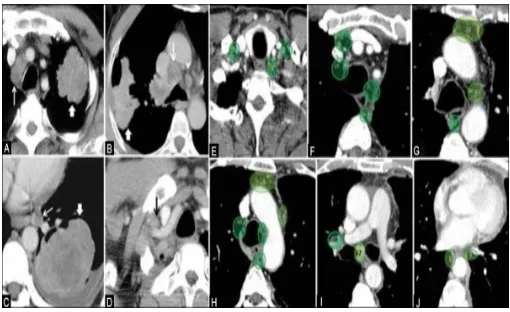 Fig 2.Lung cancer nodules. 