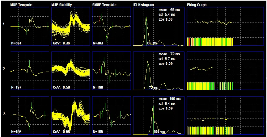 Figure 2: Decomposition summary of three MUP trains (horizontal, labelled 1-3), representing the decomposition of needle-detected EMG signal and analysis of needle- and surface-detected signals