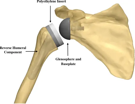 Figure 1.10: Implanted components in reverse total shoulder arthroplasty 