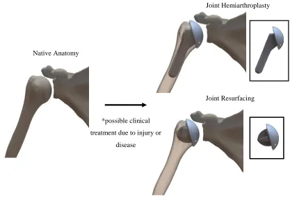 Figure 1.2: Bone removal process 