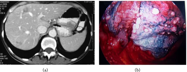 Figure 4. (a) Magnetic resonance imaging reveals hepatic impairment; (b) Bronchoscopy revealing many metastases in the pleura and lungs