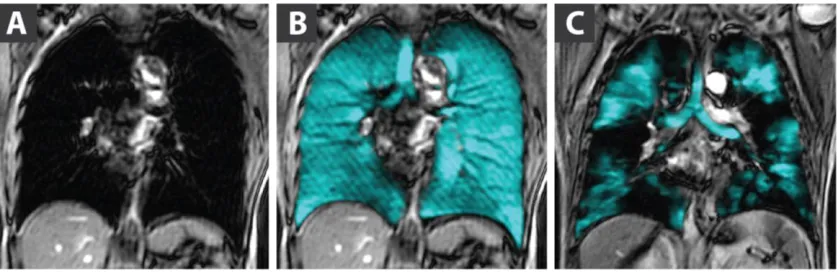 Figure 1-6: Proton and hyperpolarized helium-3 MRI of lung. Panel A shows proton image of lungs