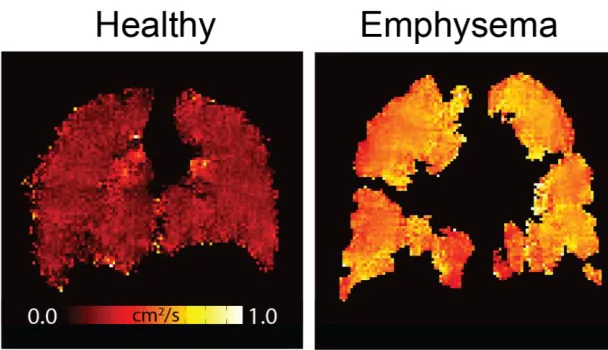 Figure 1-7: Apparent diffusion coefficient (ADC) maps. Left panel represents a healthy individual while right panel represents an individual with emphysema